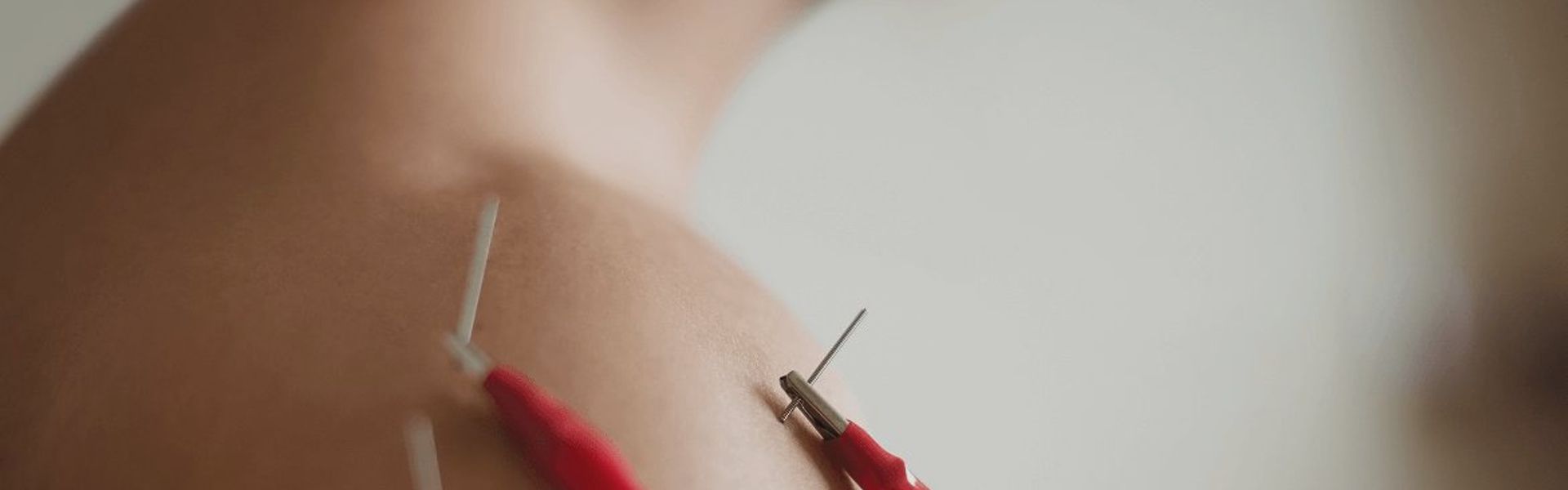 Neuromodulacion Percutanea Ecoguiada